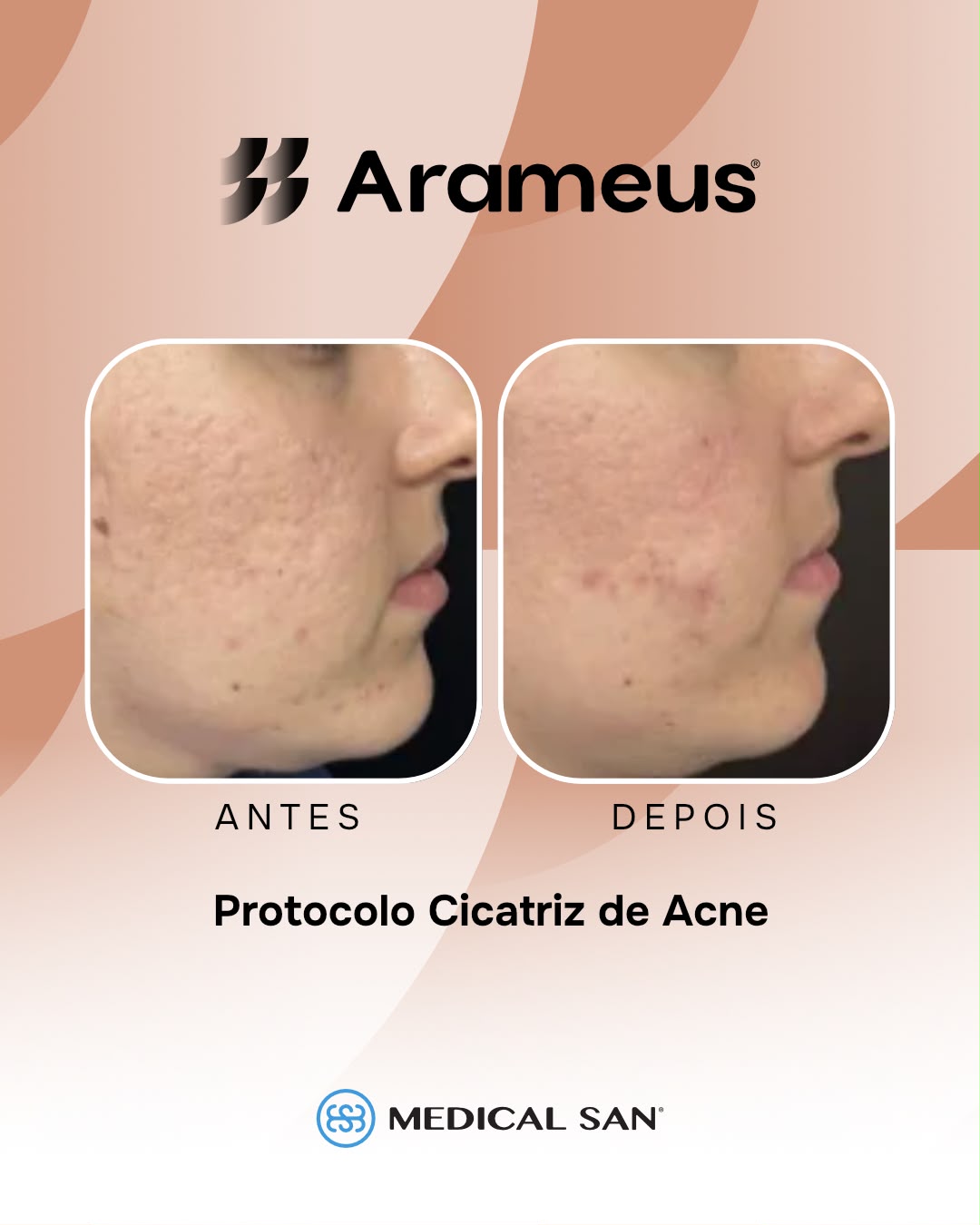 Antes e depois de protocolo para cicatriz de acne